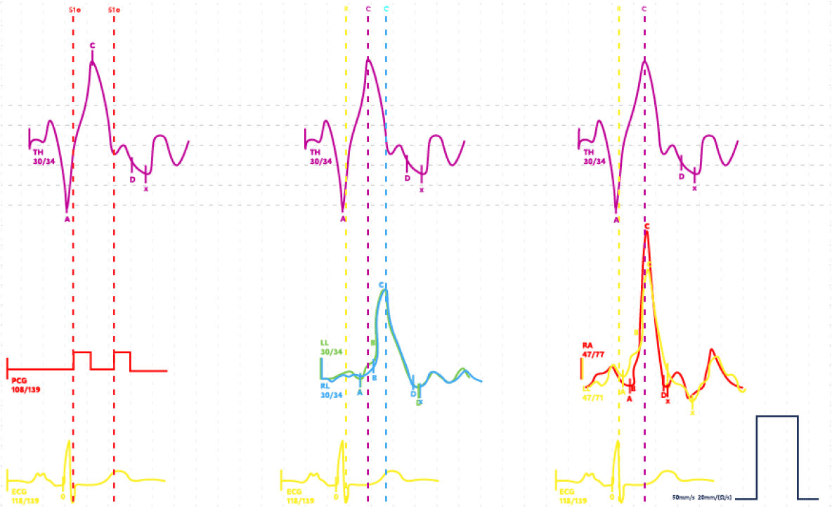 Gemittelte segmentale Plethysmogramme („Templates“) zeigen die zeitversetzte Ankunft der Volumenpulse in Thorax, Armen und Beinen – inklusive Detektion von Asymmetrien.